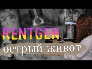 Острый живот: рентген диагностика🚑