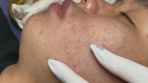 Механическая чистка лица от комедонов