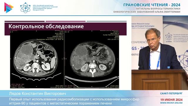 Первый опыт применения радиоэмболизации с использованием микросфер иттрия 90
