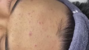 122 • Acne collection • АСМР • Relax Spa
