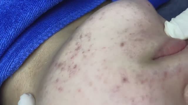 121 • Acne Collection • АСМР • Relax Spa