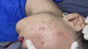 123 • Acne collection • АСМР • Relax Spa