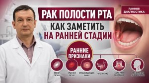 Рак полости рта: как выявить на ранней стадии