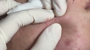 Случай лечения закрытых комедонов