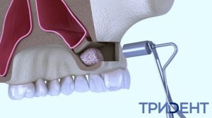 СИНУС ЛИФТИНГ | ТРИDЕНТ