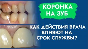 Когда коронка будет стоять долго - информация для пациента!