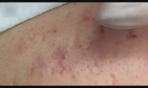 Глубокое извлечение акне и черных точек