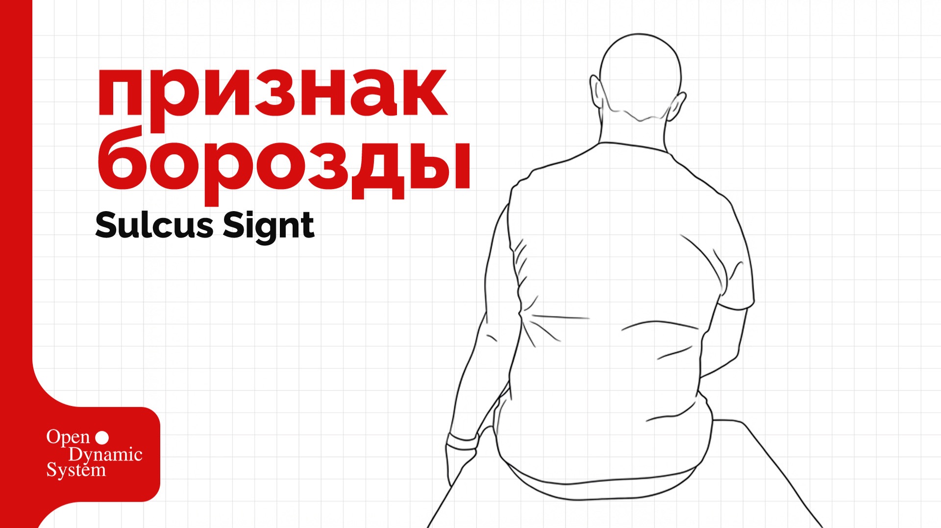Признак борозды (Sulcus Sign) - плечевой сустав