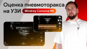 Оценка пневмоторакса на УЗИ Mindray Consona N8: норма и признаки патологии