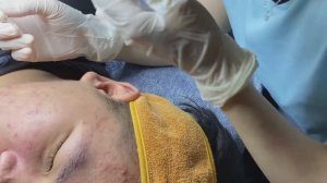Черные точки и скрытые прыщи под кожей. Полная чистка лица