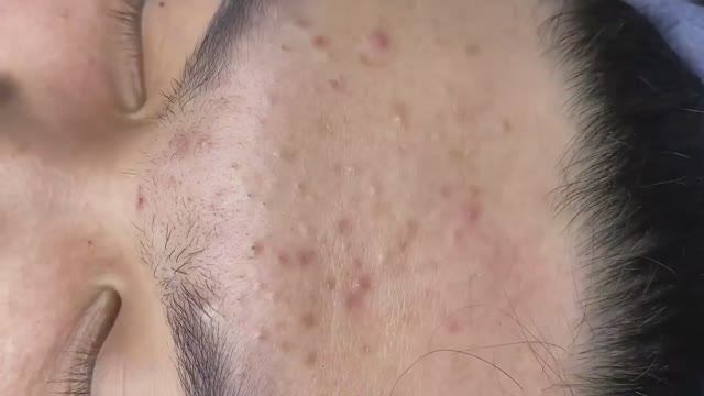127 • Acne Collection • АСМР • Relax Spa