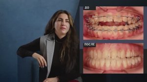 NKclinic - отзывы пациентов. Из-за прикуса болели суставы. До и после ортогнатической операции