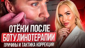 Отеки после ботокса | Причины и тактика коррекции
