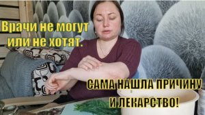 История из моей жизни. Неизлечимая болезнь и как я борюсь с ней. Себорейный дерматит