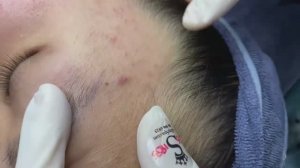 125 • Acne collection • АСМР • Relax Spa