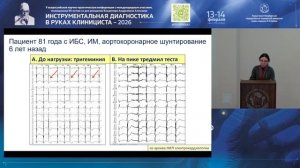 Стратификация желудочковых аритмий, на основании результатов нагрузочных проб у пациентов с ИБС