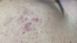126 • Acne collection • АСМР • Relax Spa