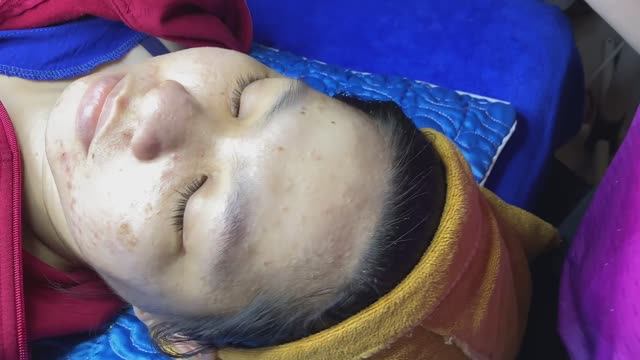Подкожные прыщи. Извлечение закрытых комедонов
