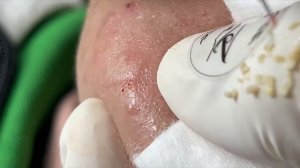 ГЛУБИННОЕ ОЧИЩЕНИЕ. Каждый комедон под микроскопом.