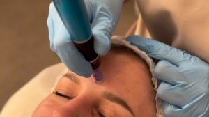 Химический пилинг PeachPeal плюс безинъекционная мезотерапия DermaPen