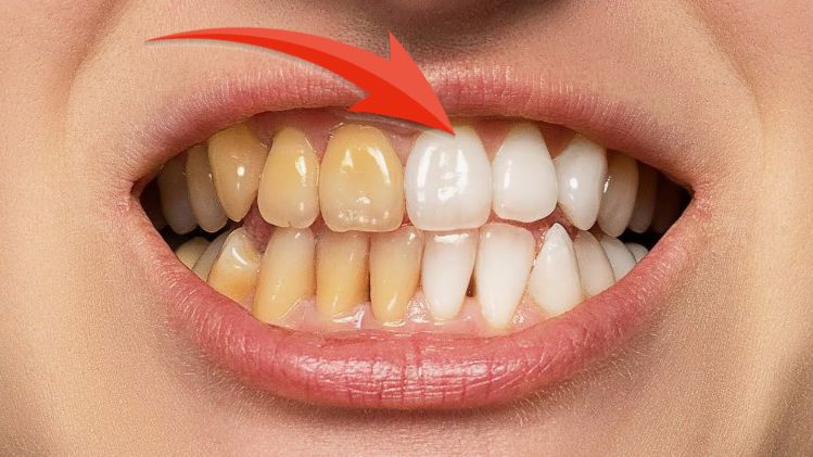 Как за 2 минуты отбелить зубы в домашних условиях, 100% результат