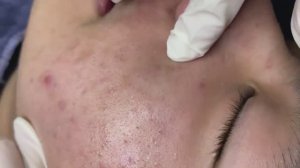 131 • Acne collection • АСМР • Relax Spa