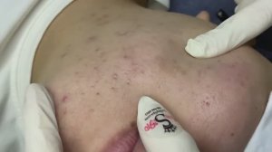 133 • Acne collection • АСМР • Relax Spa