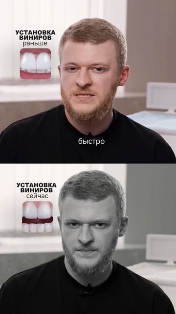 Установка виниров раньше и сейчас