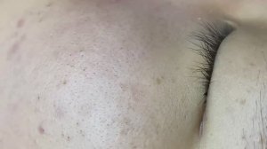 136 • Acne collection • АСМР • Relax Spa