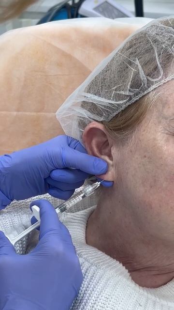Belotero Balance: коррекция мочки уха