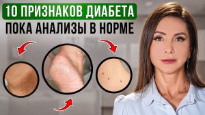 Так начинается ДИАБЕТ! Первые симптомы, на которые вы не обращаете внимание