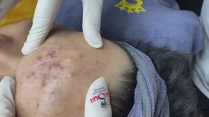 134 • Acne collection • АСМР • Relax Spa