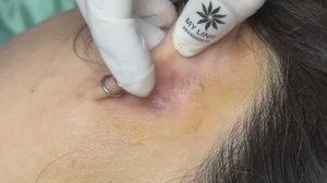 Удаление кисты и прыщей за ухом.