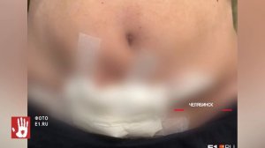 За полмиллиона рублей она получила гной и дыры в животе: женщина чуть не умерла после пластики