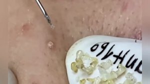 Выдавливание прыщей, угрей, черных точек и камедонов #437