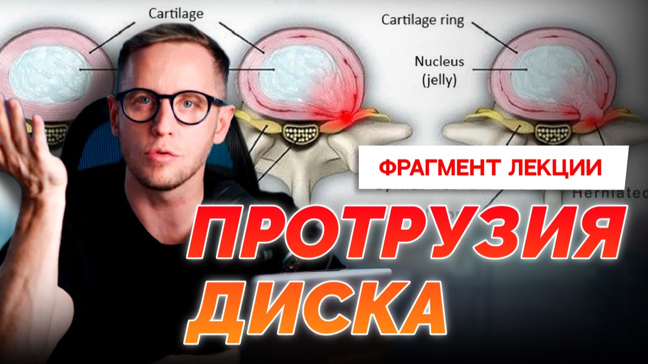 ПРОТРУЗИЯ: что это на самом деле. Как врут описания МРТ