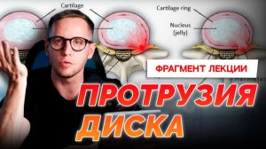 ПРОТРУЗИЯ: что это на самом деле. Как врут описания МРТ