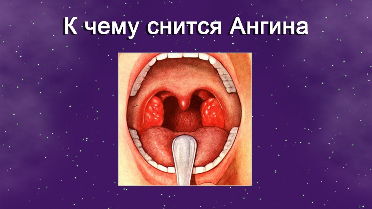К чему снится Ангина - толкование сна