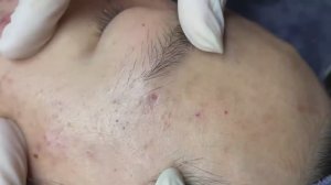 137 • Acne collection • АСМР • Relax Spa