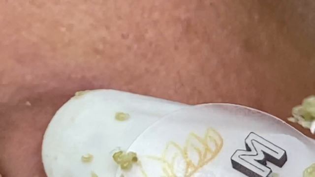 Удаление прыщей с жирной и проблемной кожи