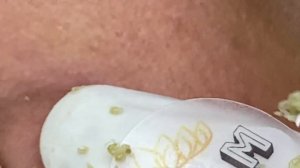 Удаление прыщей с жирной и проблемной кожи