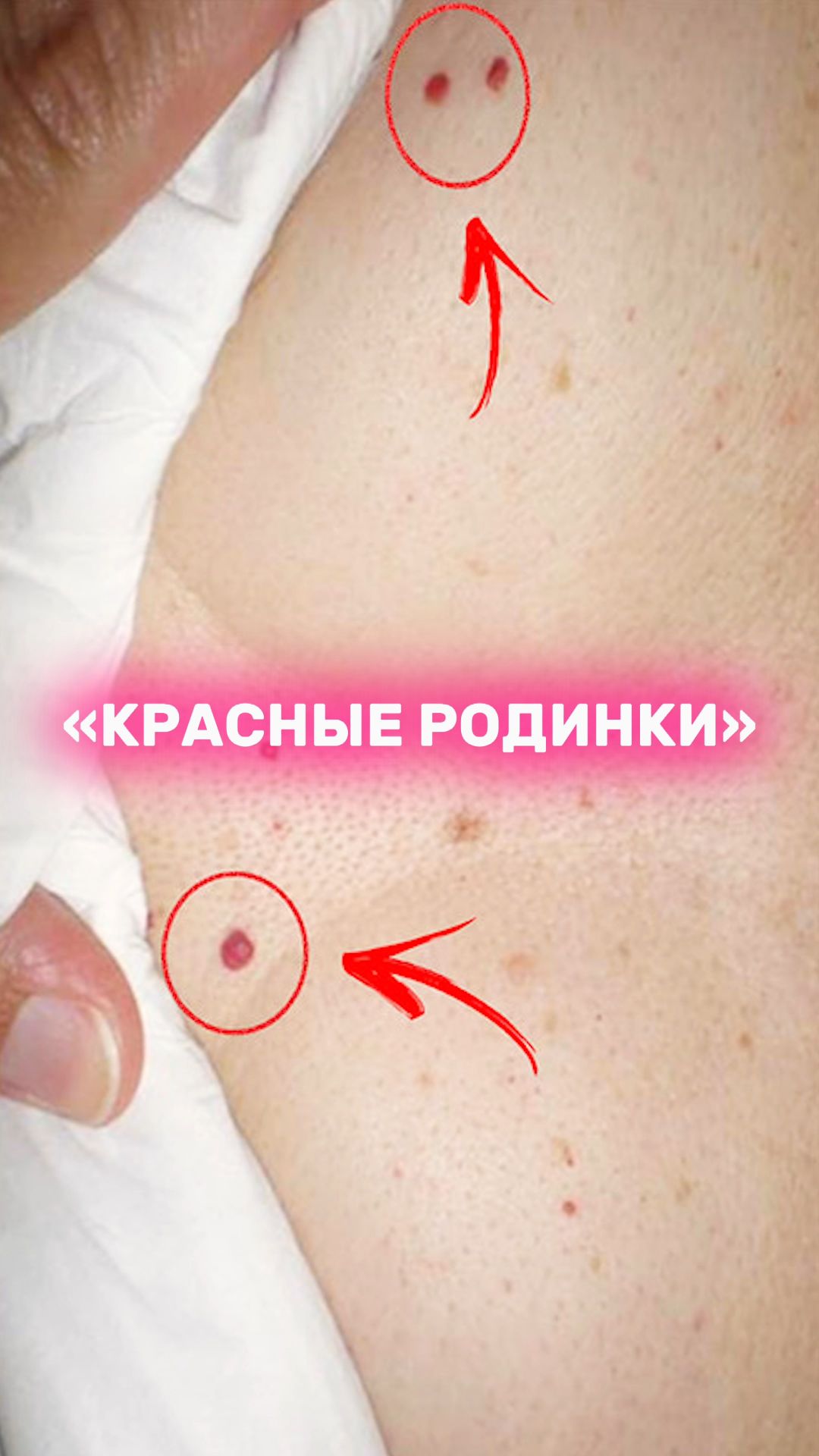 Красные точки на теле. Чем опасны гемангиомы? Как избавиться?