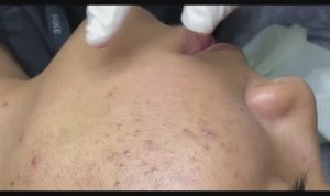 Механическая чистка от закрытых комедонов. Расслаблющее видео.