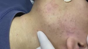 140 • Acne collection • АСМР • Relax Spa