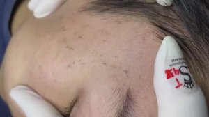 139 • Acne collection • АСМР • Relax Spa