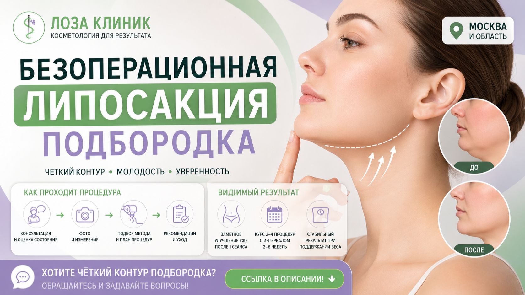 Как проходит безоперационная липосакция подбородка смотреть онлайн
