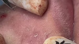 Механическое очищение кожи от ужасных угрей. Часть 2