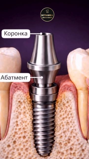 Имплантация зуба