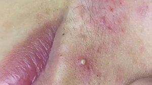 143 • Acne collection • АСМР • Relax Spa
