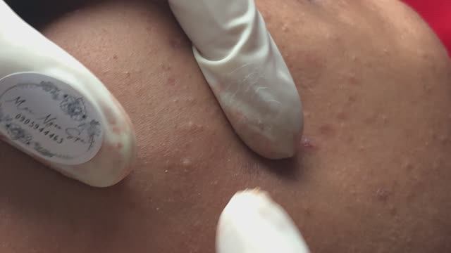 Чистка кожи от угревой сыпи. Рабочая схема.